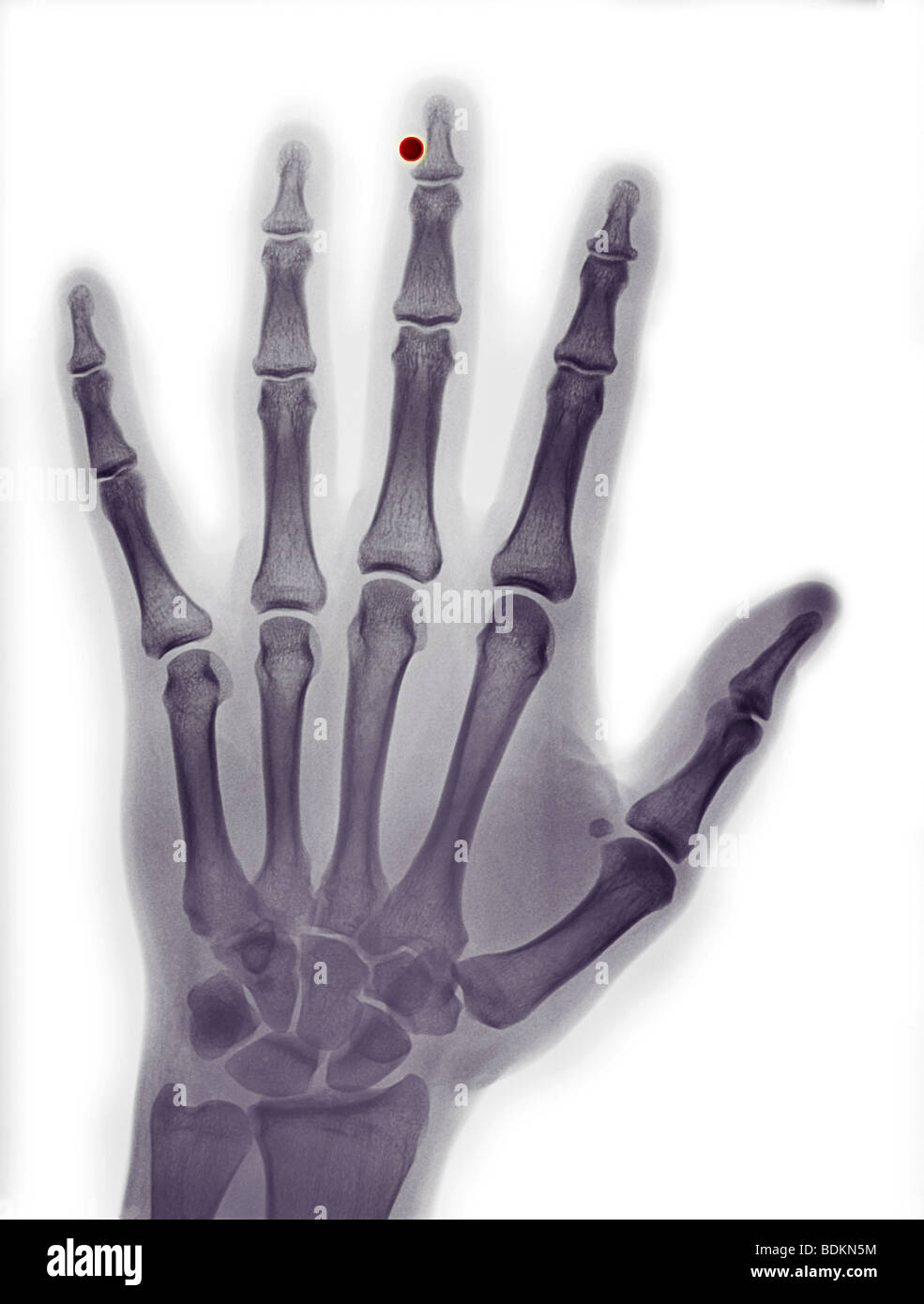 x-ray of the hand of a 23 year old man showing a BB embedded in his middle finger Stock Photo