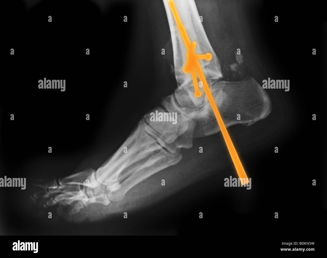 x-ray of the foot of an 61 year old woman with a comminuted fracture of the ankle that was surgically repaired Stock Photo