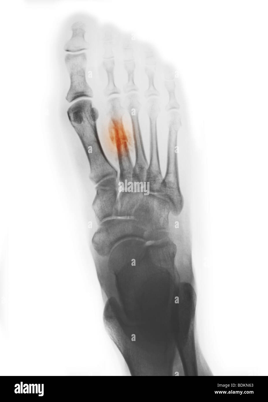 x-ray of the foot of a 44 year old woman showing a healing fracture of the second metatarsal Stock Photo