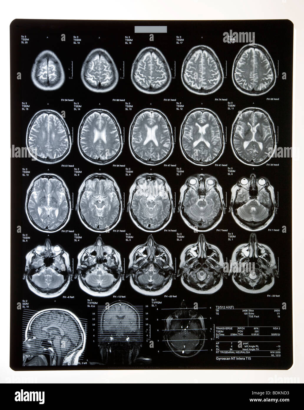 MRI SCANS or XRAYS of head showing brain and skull. Stock Photo