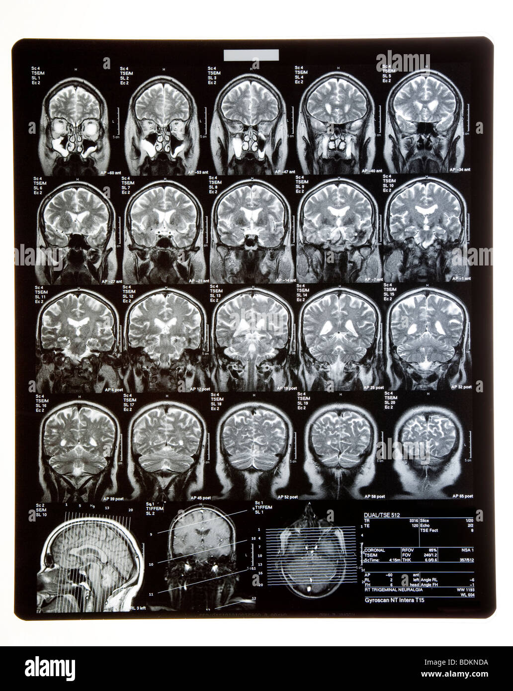 MRI SCANS or XRAYS of head showing brain and skull. Stock Photo