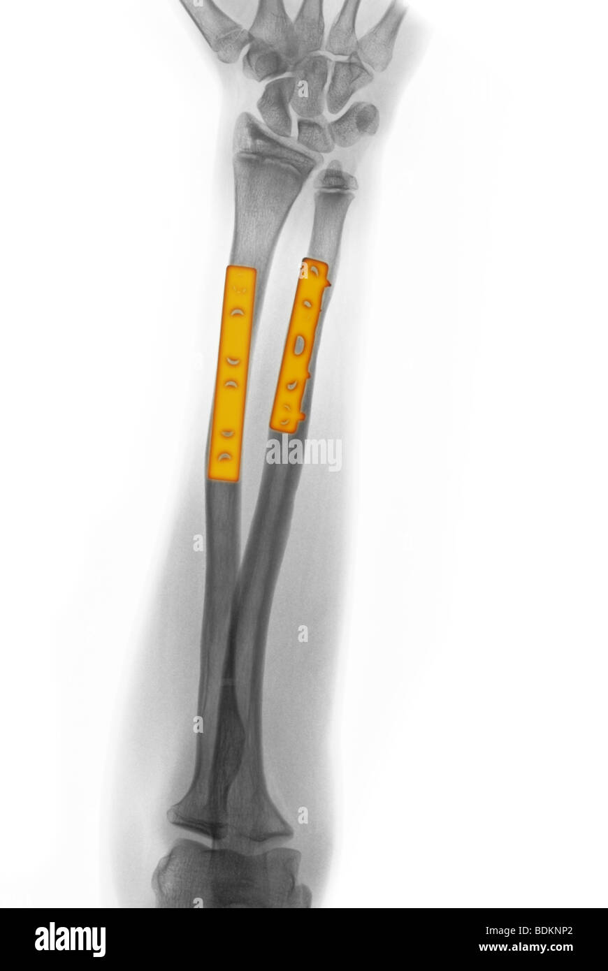 Orif surgery hi-res stock photography and images - Alamy