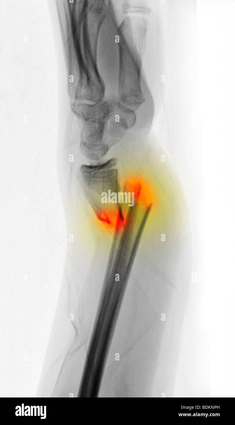 x-ray showing a severely displaced radius and ulna forearm fracture in a 12 year old girl Stock Photo