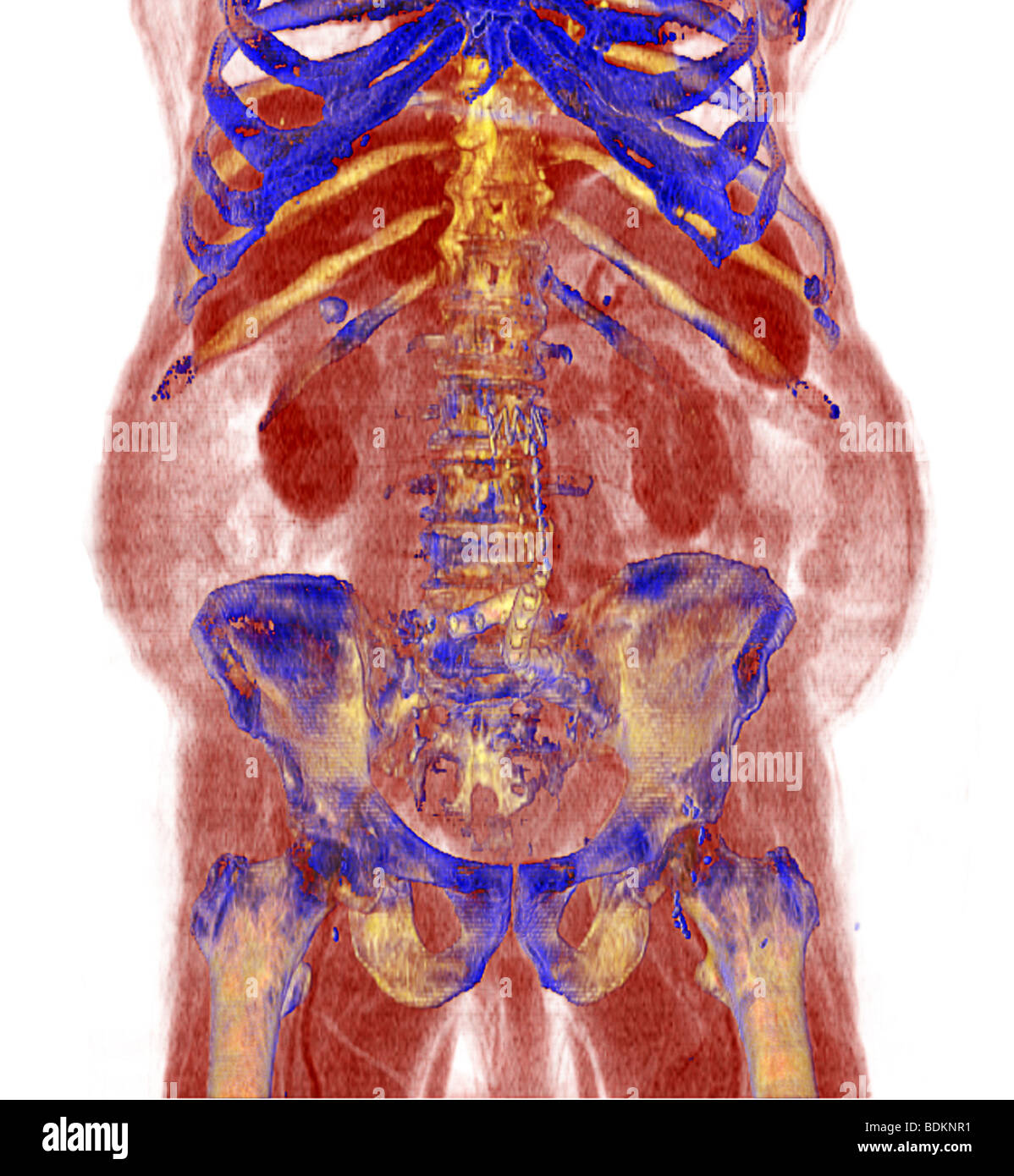 Color enhanced three-dimensional CT scan image of an 80 year old obese man. Stock Photo