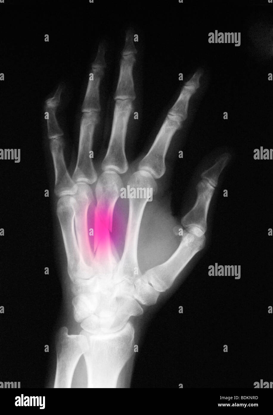 Metacarpal Fracture High Resolution Stock Photography and Images Alamy