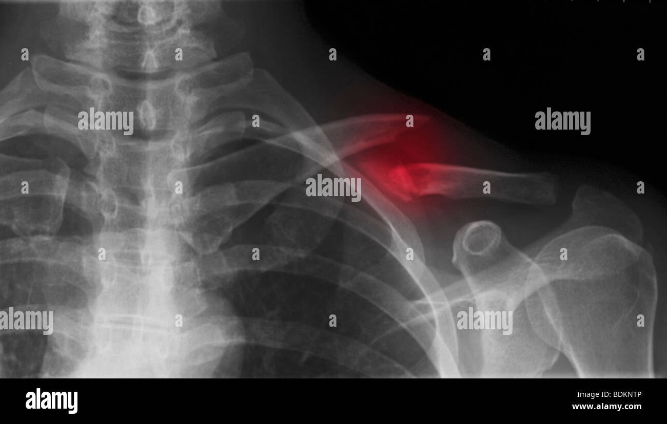 x-ray showing a clavicle fracture 50 year old female Stock Photo