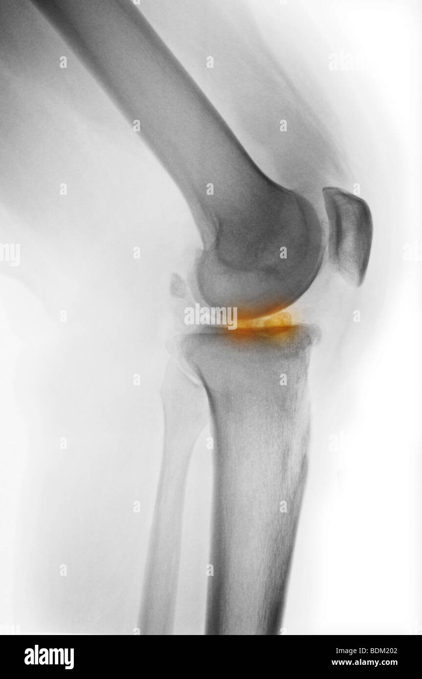x-ray of the knee of a 28 year old man with degenerative changes in the knee, including loose bodies shown in orange Stock Photo
