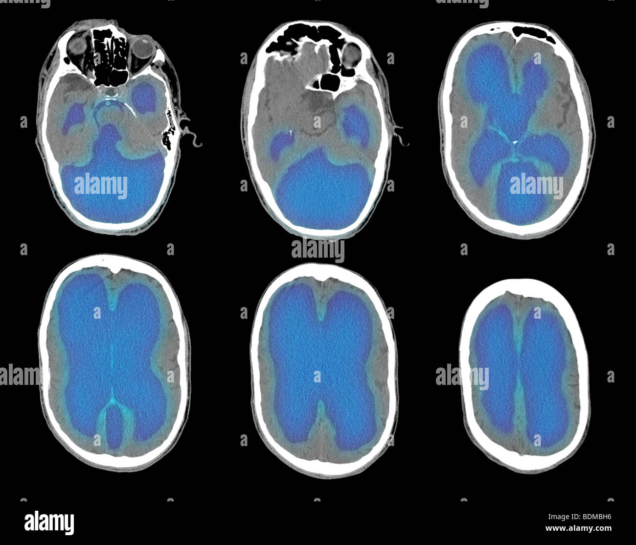 CT scan images from a 67 year old man showing severe hydrocephaly Stock Photo