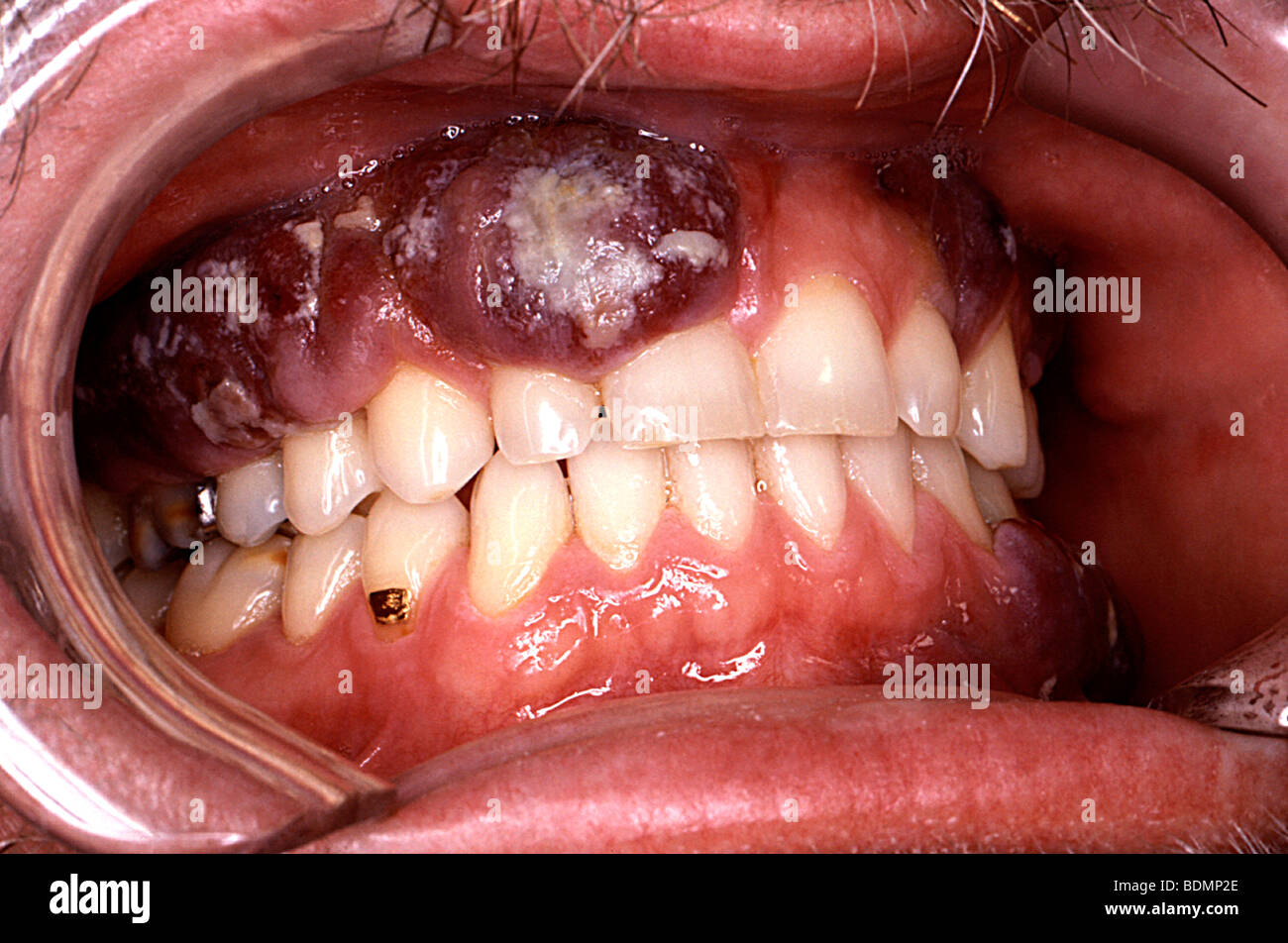 Intraoral Kaposi's sarcoma lesion with an overlying candidiasis infection in an HIV-positive patient Stock Photo