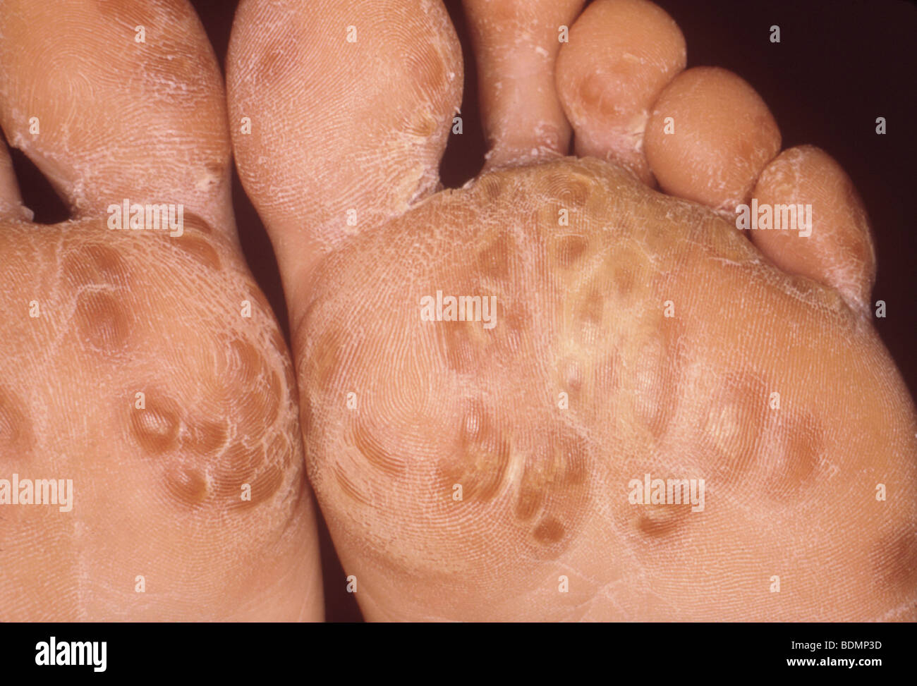 Rash On The Bottom Of The Feet Called Keratoderma Blennorrhagica In A Patient Suffering From Reiter S Syndrome Stock Photo Alamy