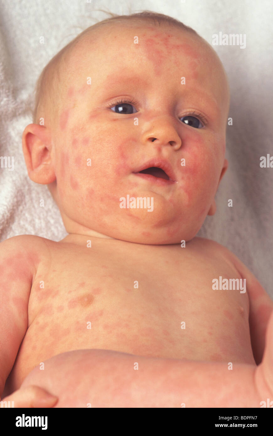 baby with viral rash all over his body Stock Photo - Alamy
