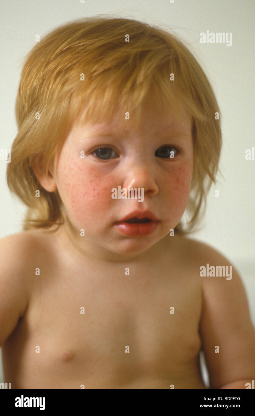child with viral rash on face Stock Photo