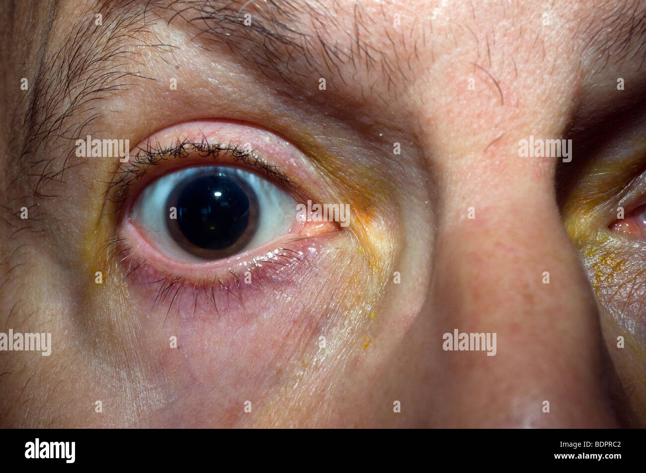 Dilated pupil of patient after undergoing ophthalmic examination in New