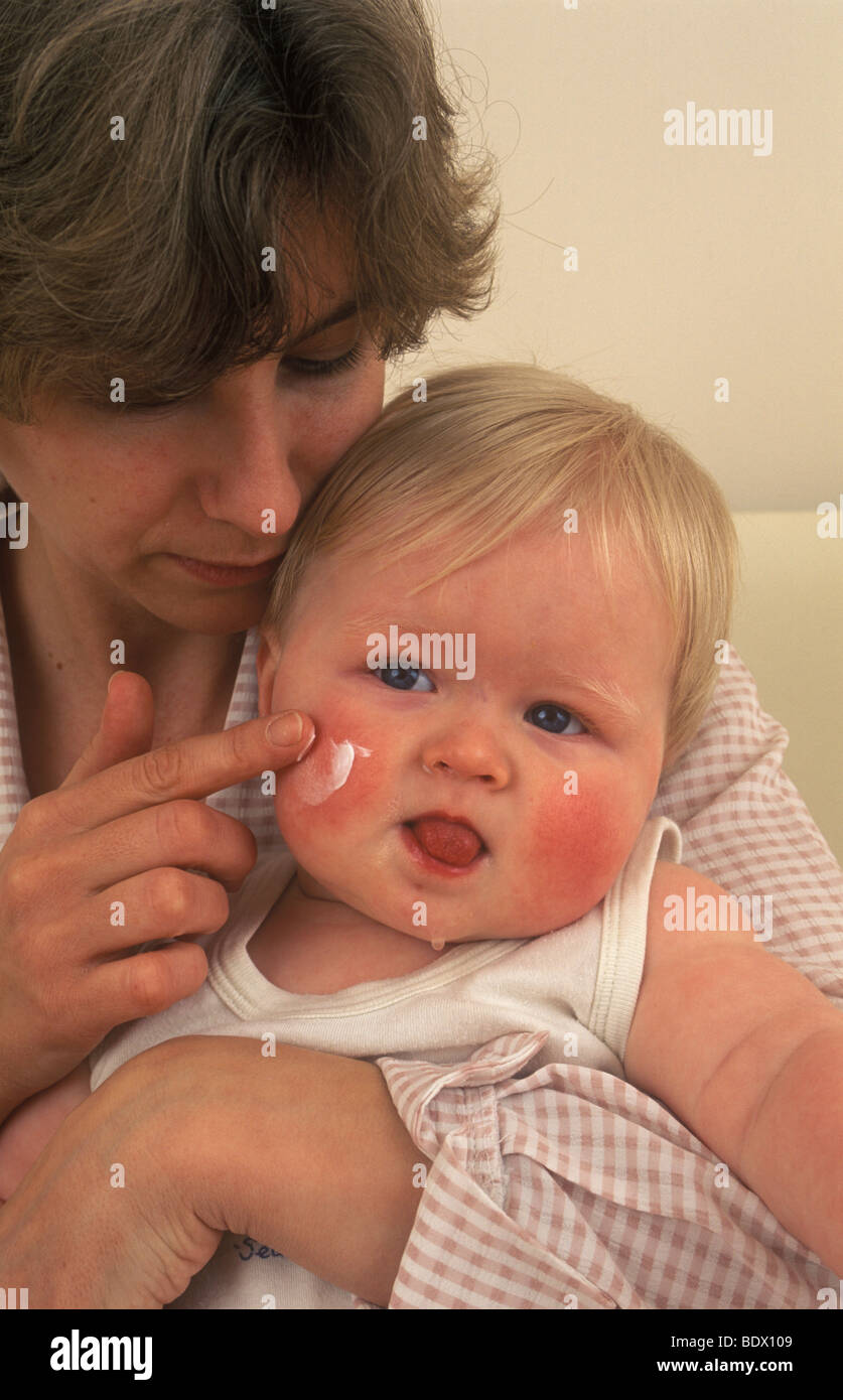 mother rubbing cream into her baby's red sore cheek Stock Photo