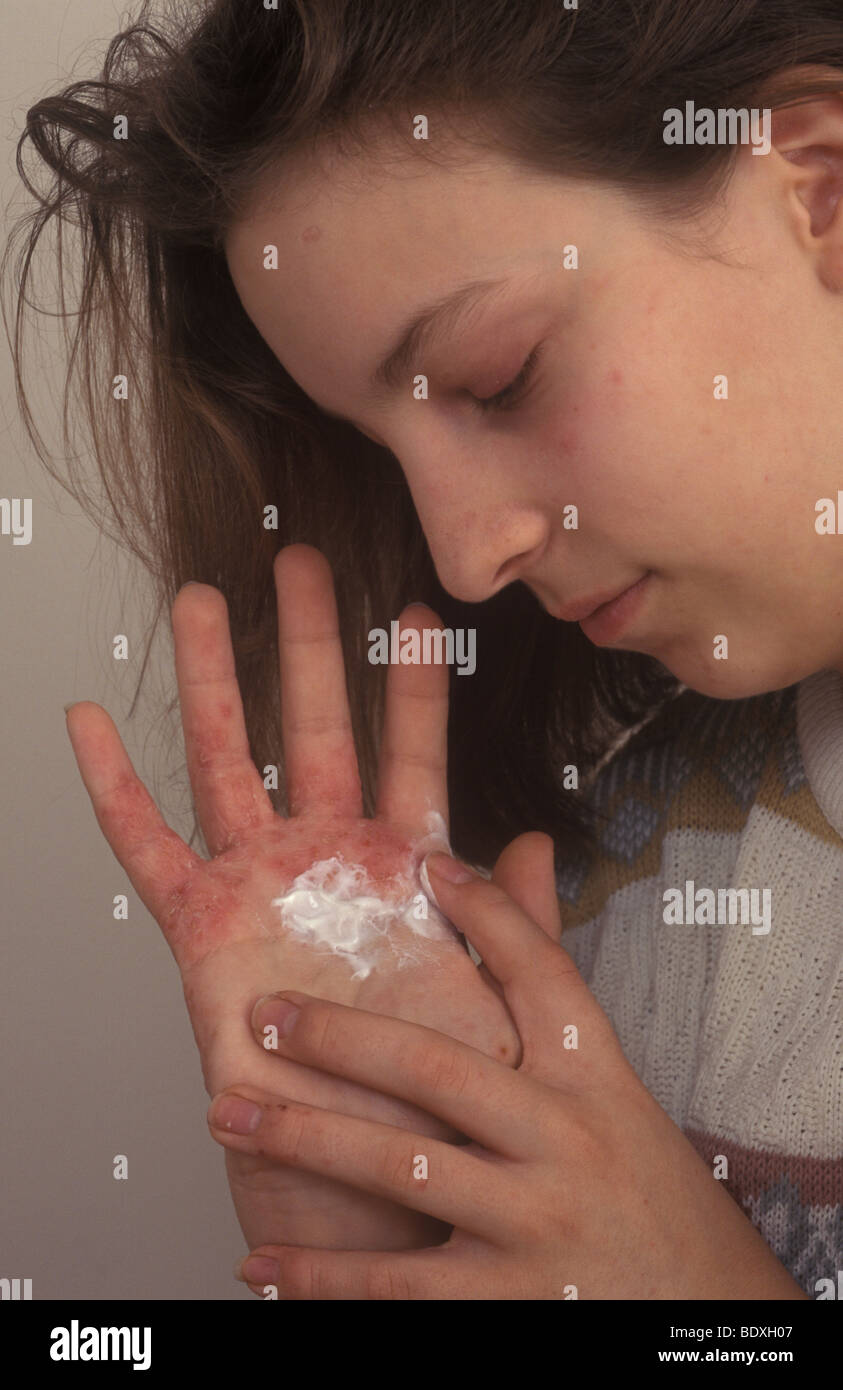 girl putting cream onto itchy eczema on her hand Stock Photo