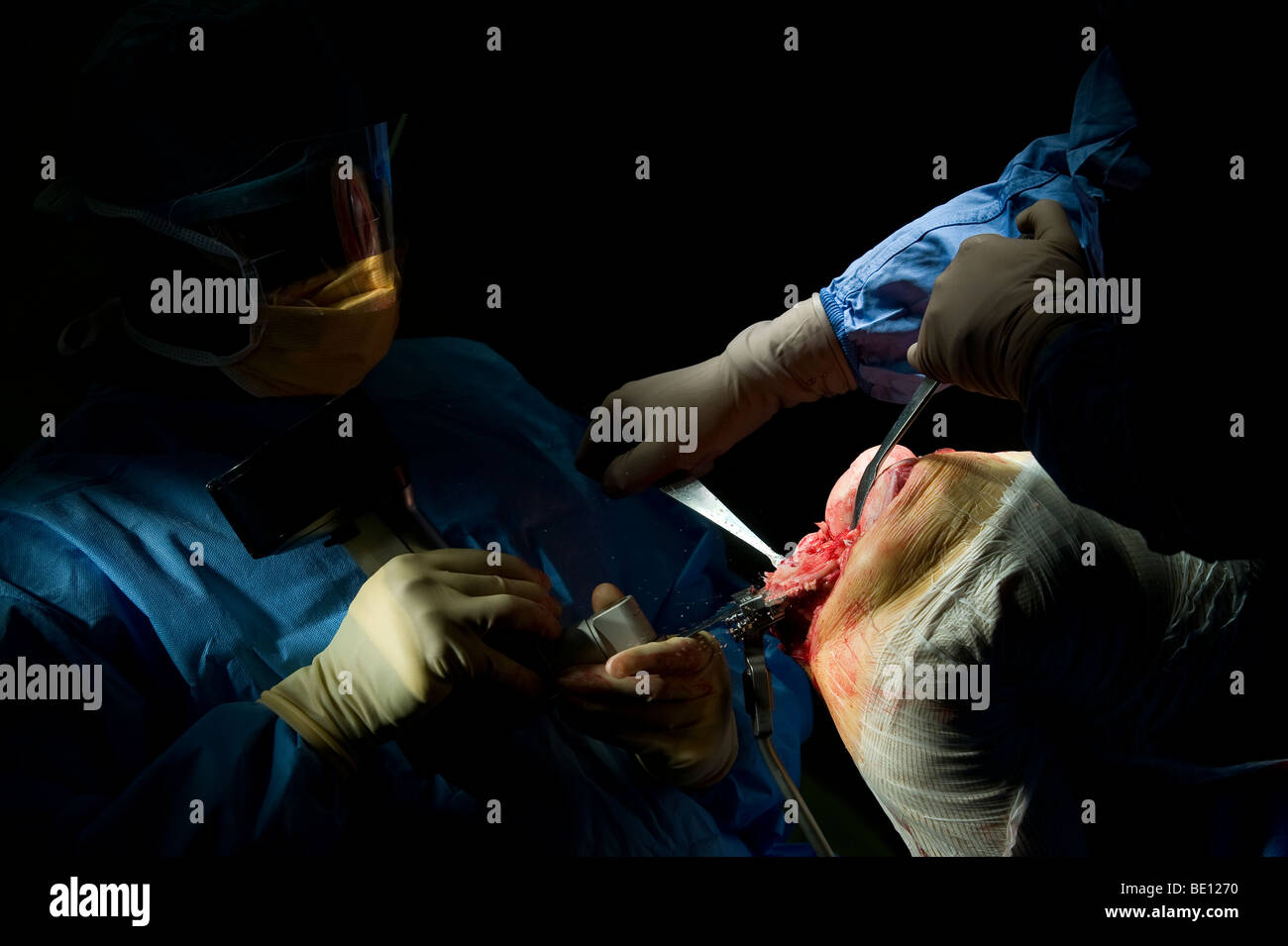 A patient undergoes knee replacement surgery at a West Midlands hospital, after being diagnosed with irreparable damage Stock Photo