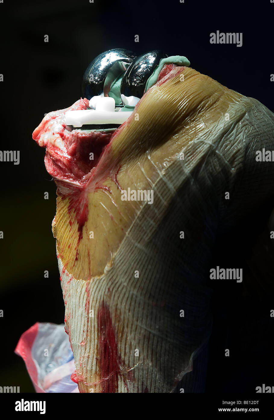 A patient undergoes knee replacement surgery at a West Midlands hospital, after being diagnosed with irreparable damage Stock Photo