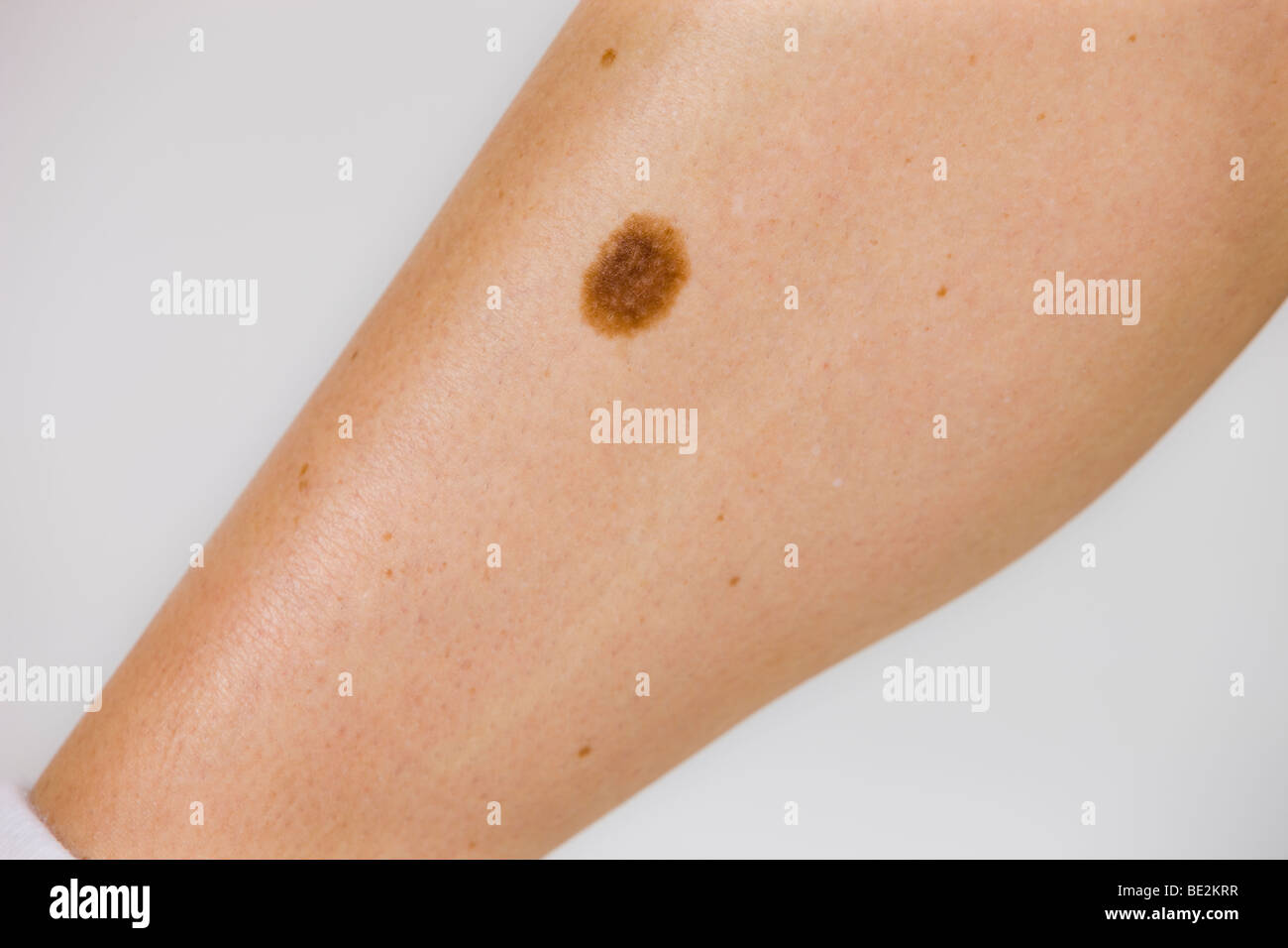 Birthmark, skin cancer risk Stock Photo