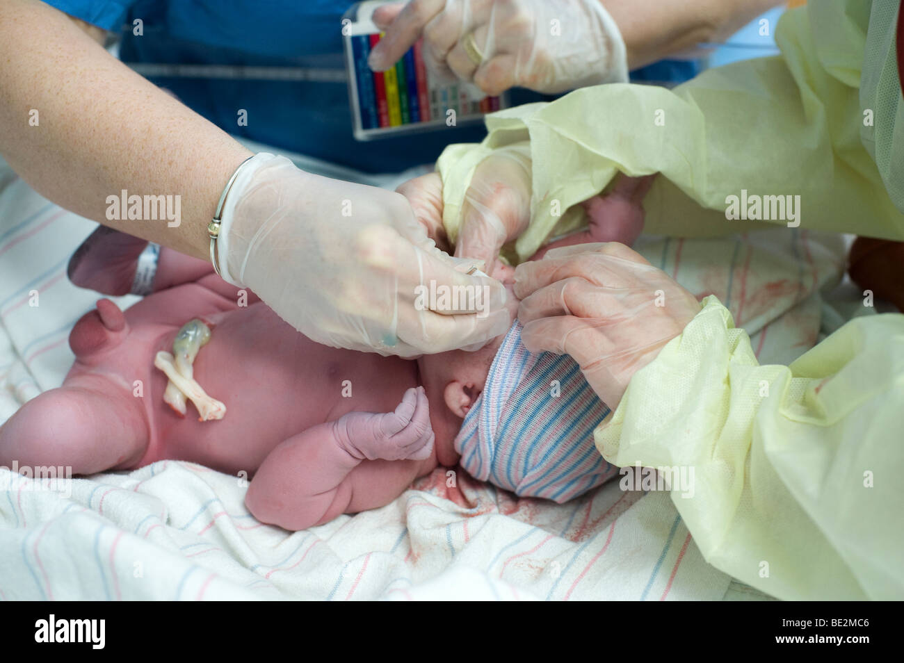 Newborn hispanic baby is given prophylactic eye drops immediately after