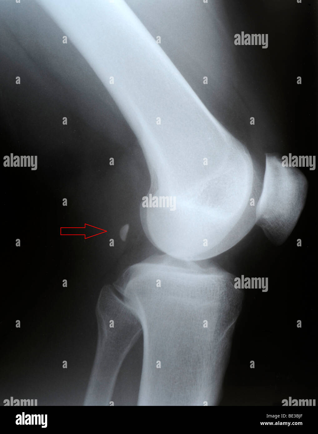 X-ray of the knee, lateral, fabella, sesamoid bone (Os sesamoideum musculi gastrocnemii), arrow, pointer Stock Photo