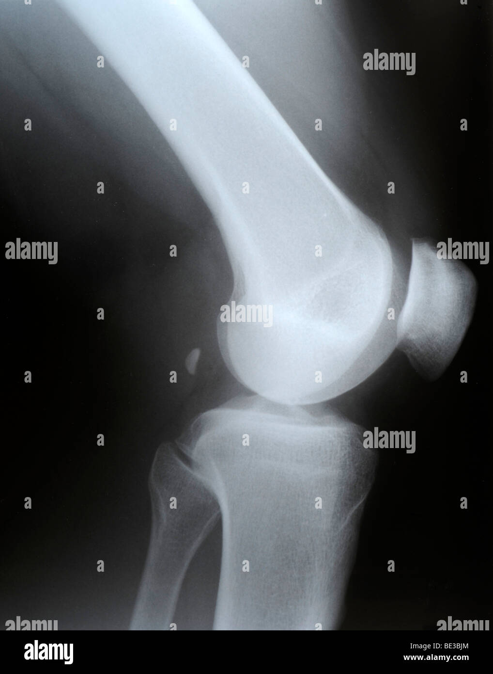 X-ray of the knee, lateral, fabella, sesamoid bone (Os sesamoideum musculi gastrocnemii) Stock Photo