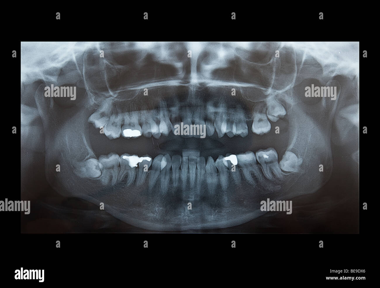 X-Ray of problematic wisdom teeth for extraction, and fillings Stock Photo