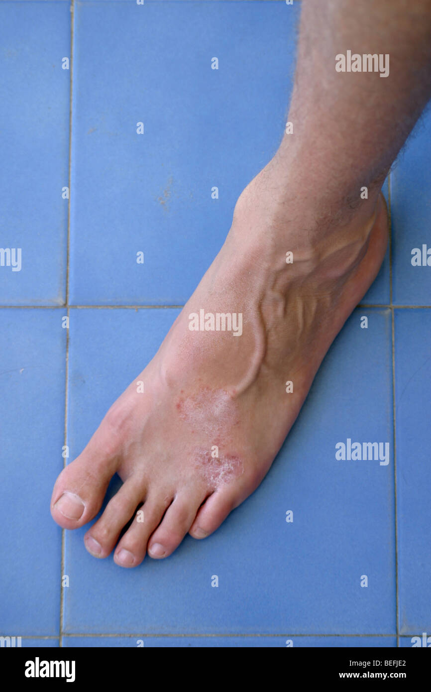 Athletes foot fungal infection  - SerieCVS217090 Stock Photo