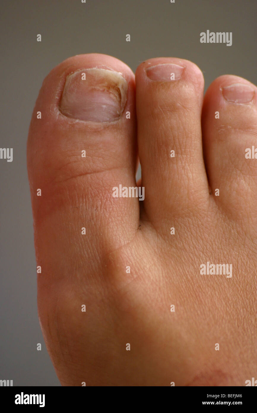Close up female feet with ungal toenail infection candidal