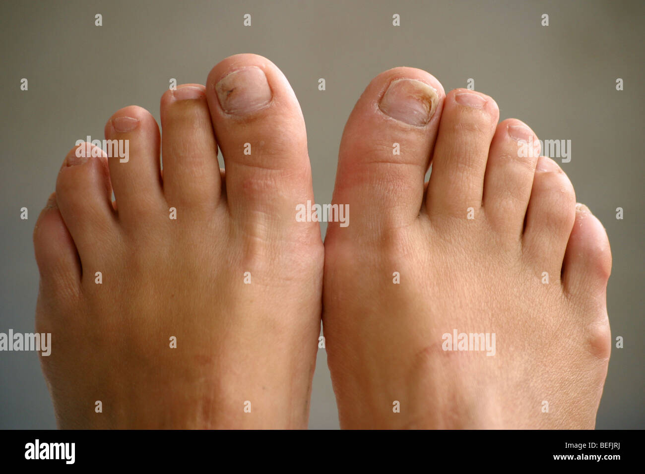 Close up female feet with ungal toenail infection candidal
