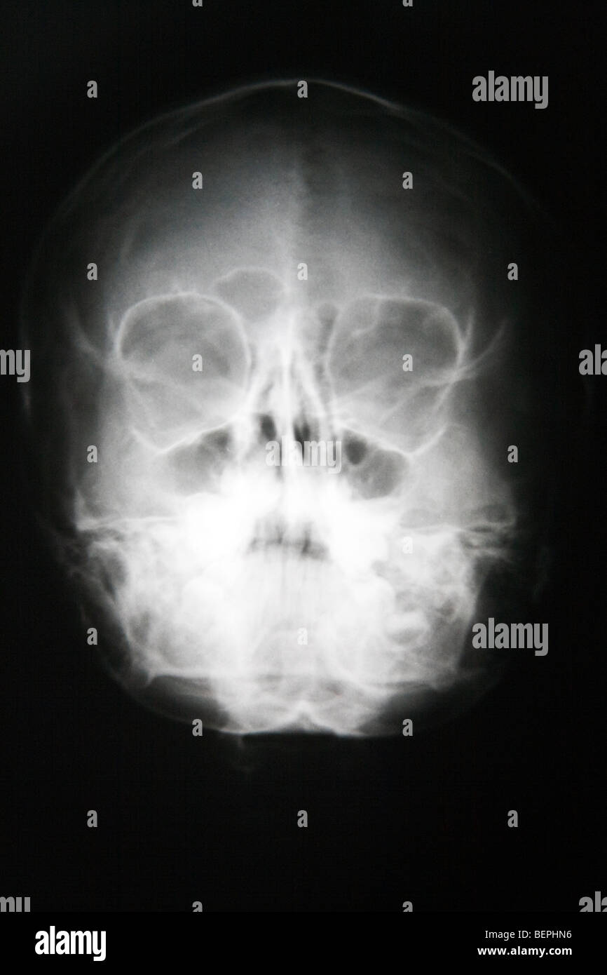 Radiography of a child's head, Seville, Andalusia, Spain Stock Photo