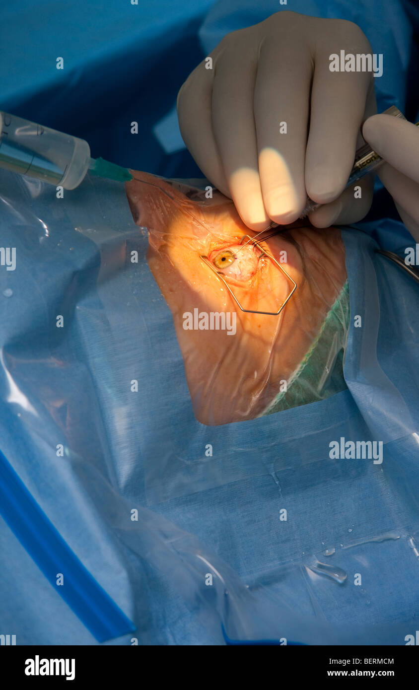 Eye operation - lens implanting Stock Photo