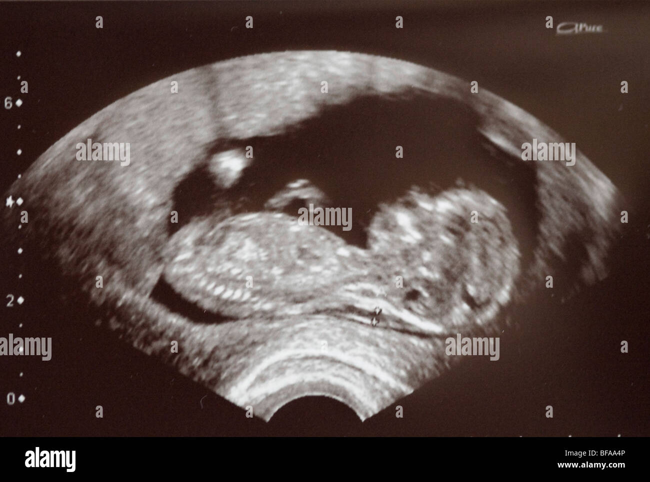Sonogram of a foetus Stock Photo