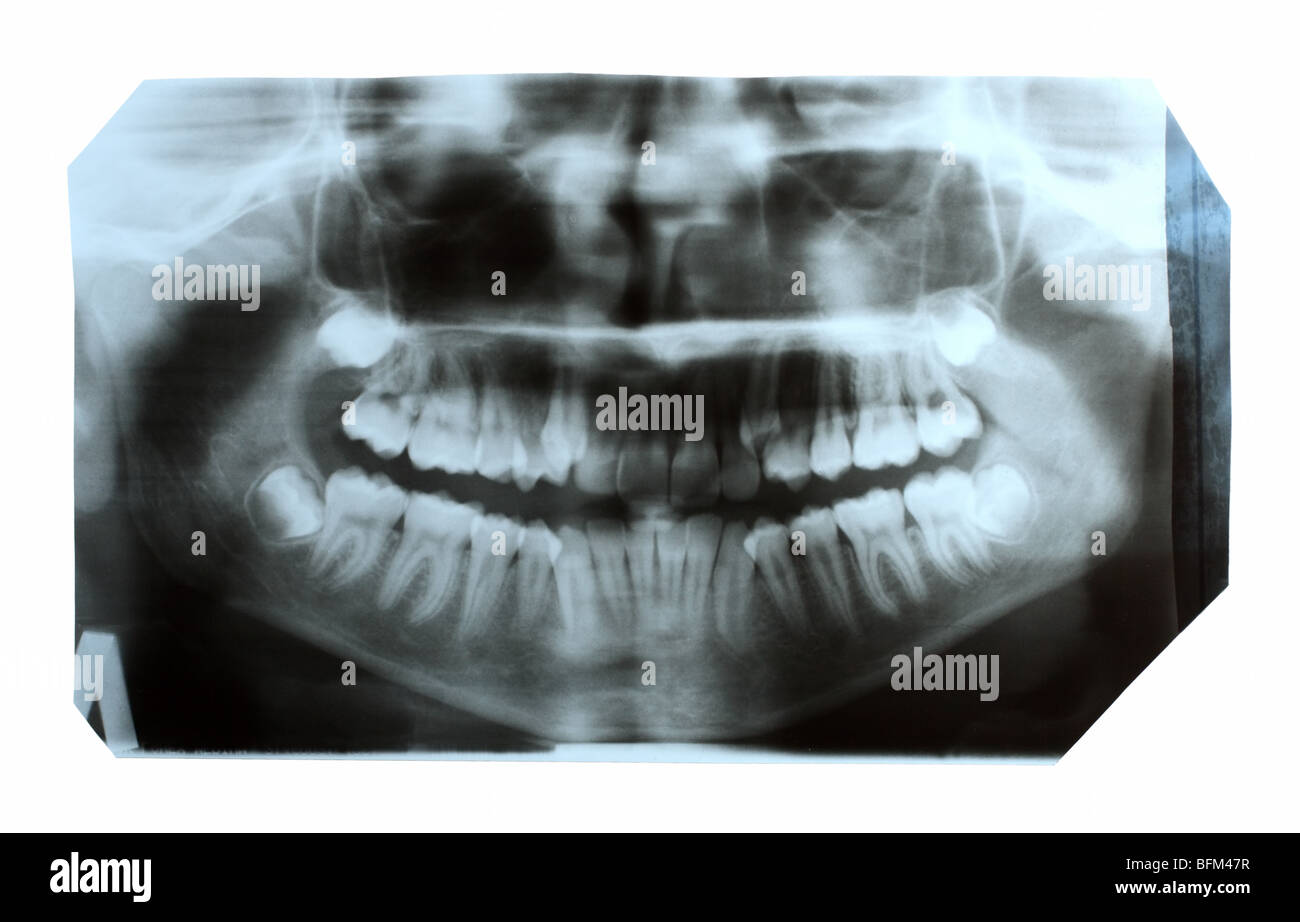 dental xray picture of jaw with teeth Stock Photo Alamy