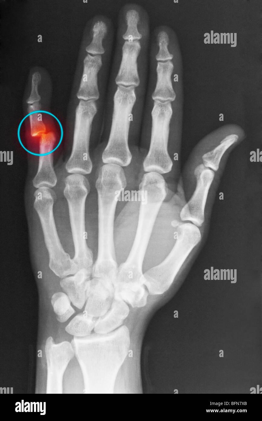 hand xray showing a dislocation of the proximal interphalangeal joint