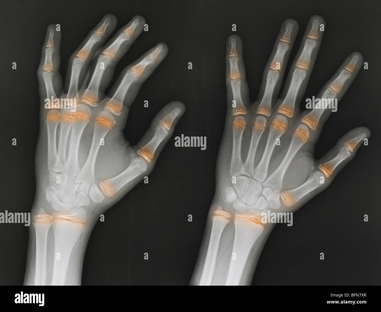 hand x-ray 12 year old male, two views with the epiphyseal growth plates highlighted in color Stock Photo
