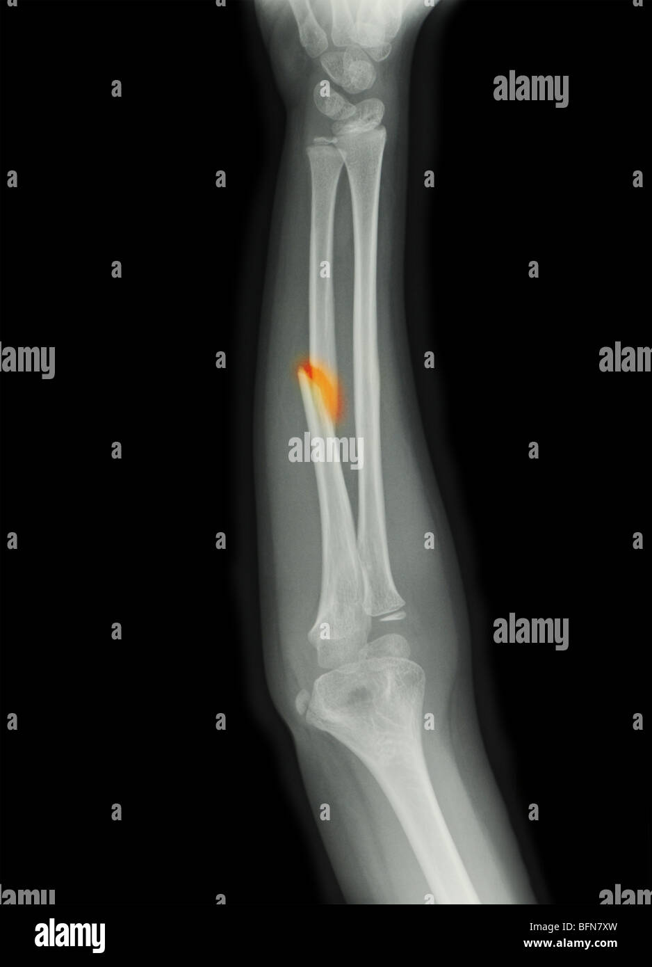 colorized x-ray showing a fracture of the ulna in an eight year old boy Stock Photo