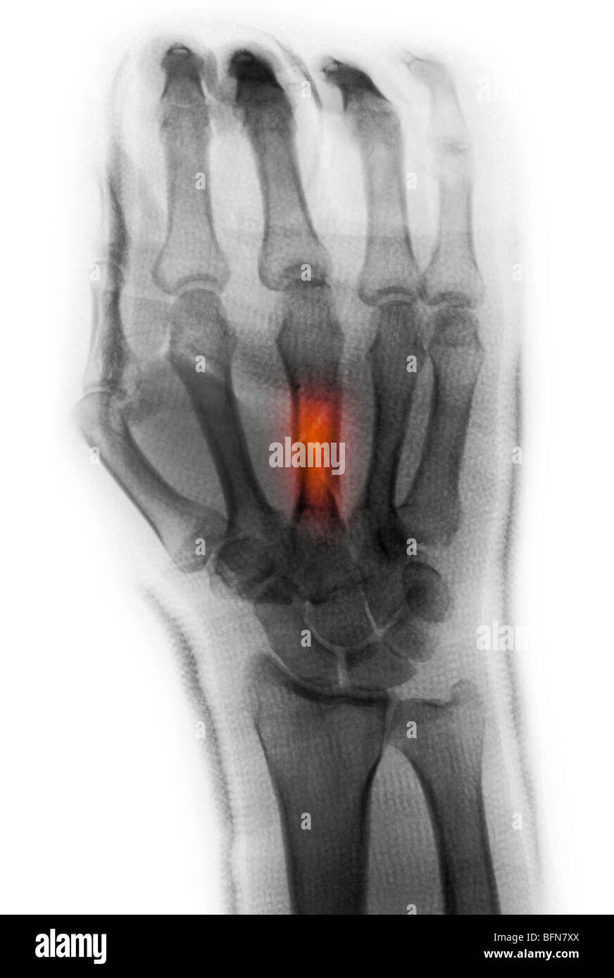 colorized x-ray showing a splinted comminuted fracture of the middle metacarpal in a 50 year old man Stock Photo