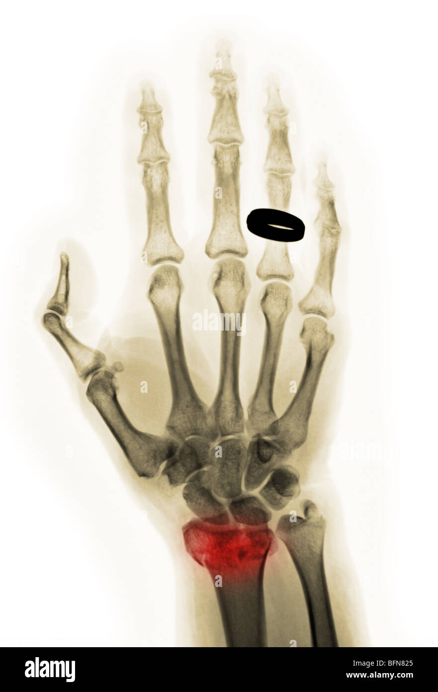 x-ray showing a comminuted fracture of the distal radius of the wrist of a 51 year old woman with osteoporosis Stock Photo