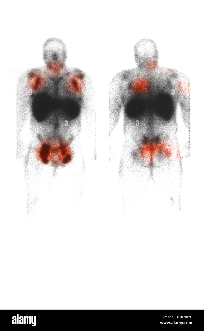Radionucleotide full body scan using  radiolabeled monoclonal antibodies showing  cancer Stock Photo