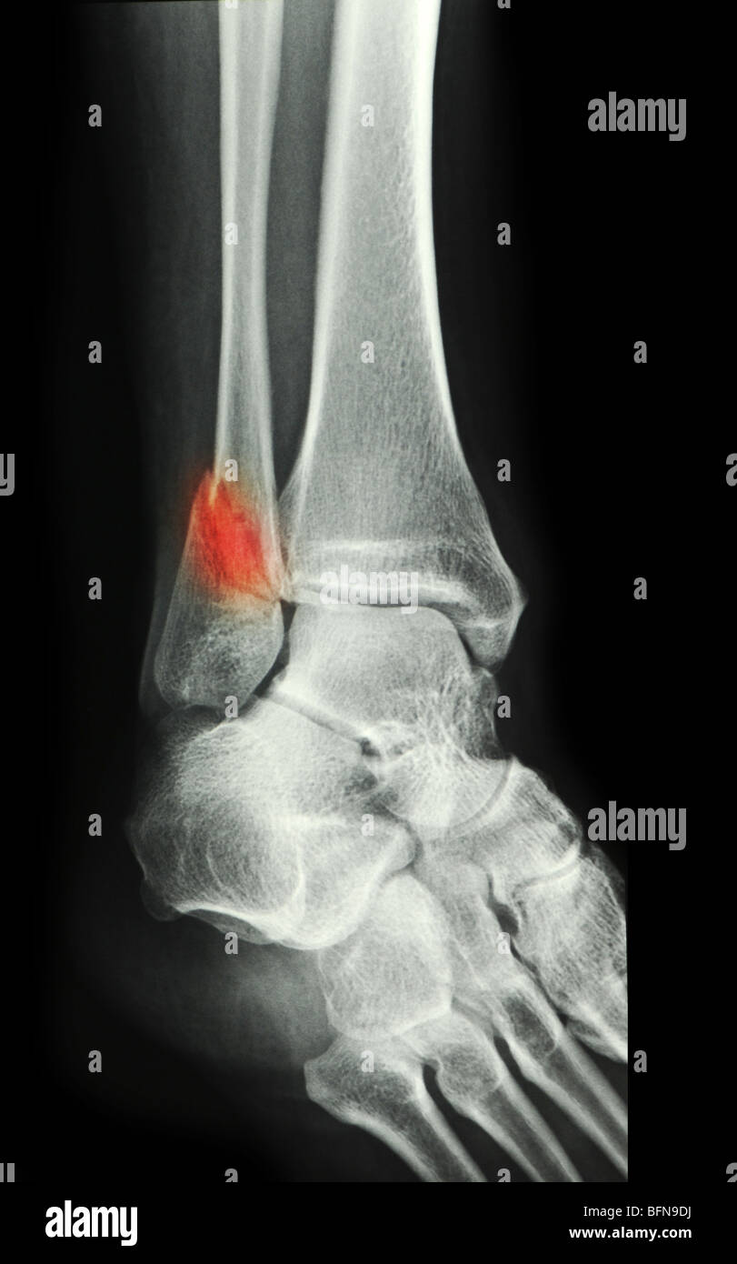 x-ray showing an ankle fracture oof a 49 year old woman Stock Photo