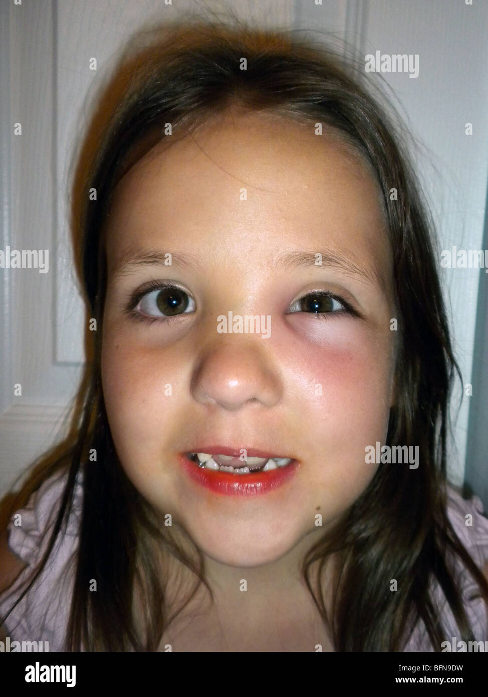 An Eight Year Old Girl Who Was Stung Near Her Left Eye By A Wasp An Eight Year Old Girl Who Was Stung Near Her Left Eye By A Wasp