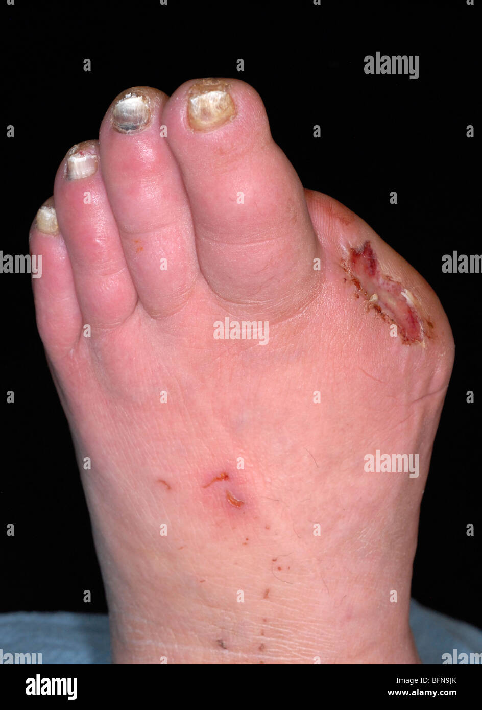 Series of photographs showing diabetic ulcers and toe amputations secondary to poor circulation and infections. Stock Photo