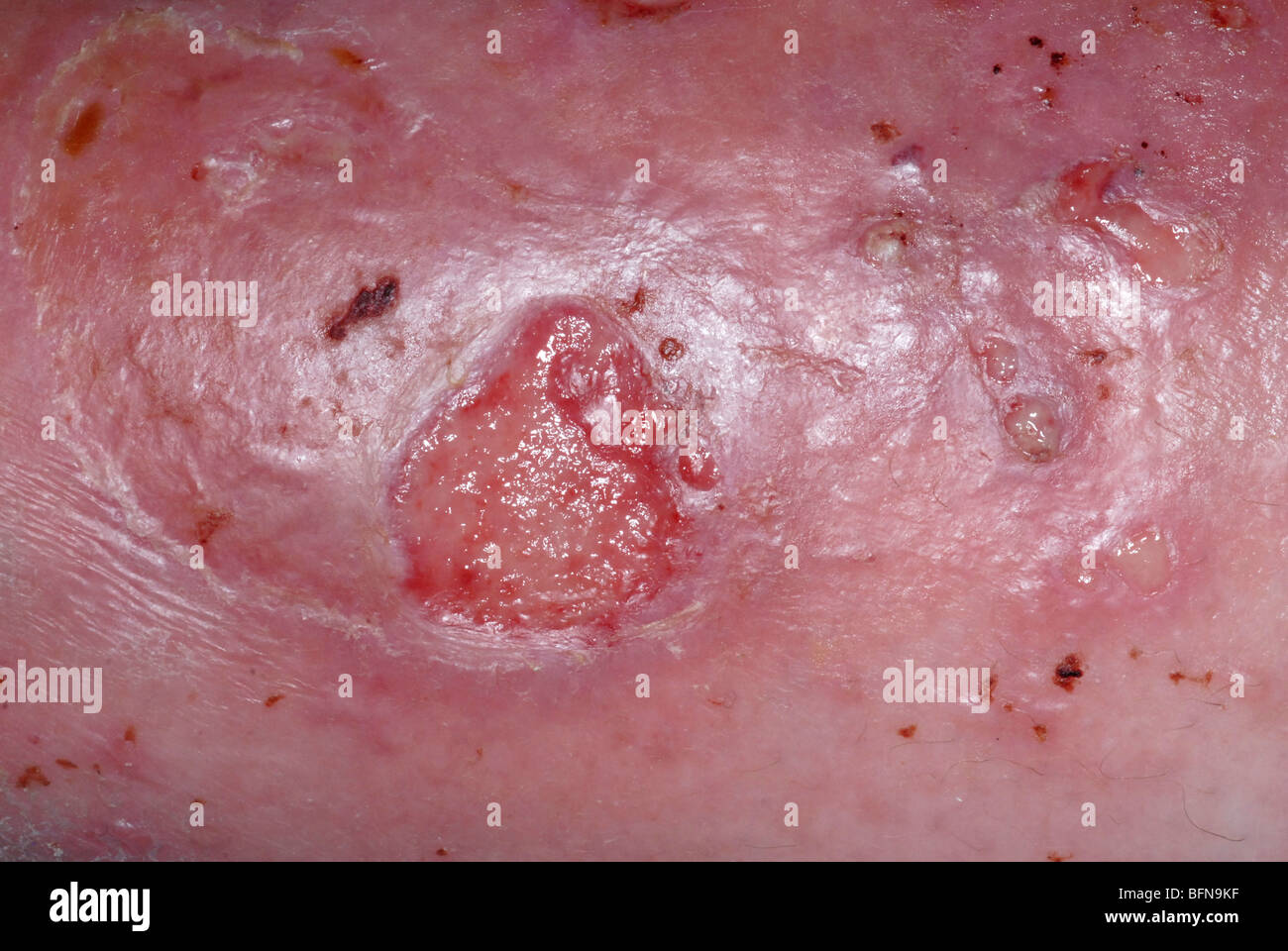 Series of photographs showing diabetic ulcers and toe amputations secondary to poor circulation and infections. Stock Photo