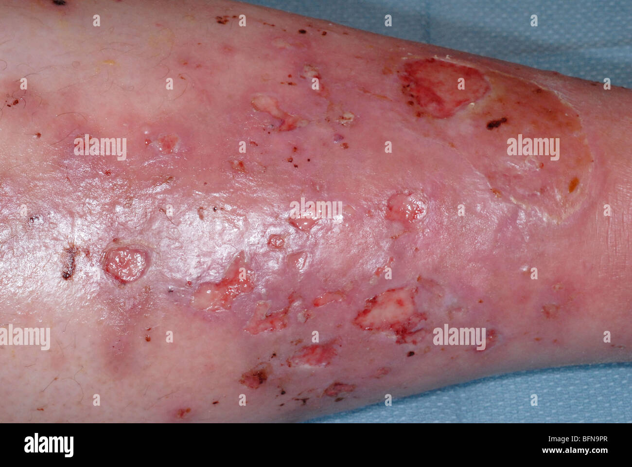 Series of photographs showing diabetic ulcers and toe amputations secondary to poor circulation and infections. Stock Photo