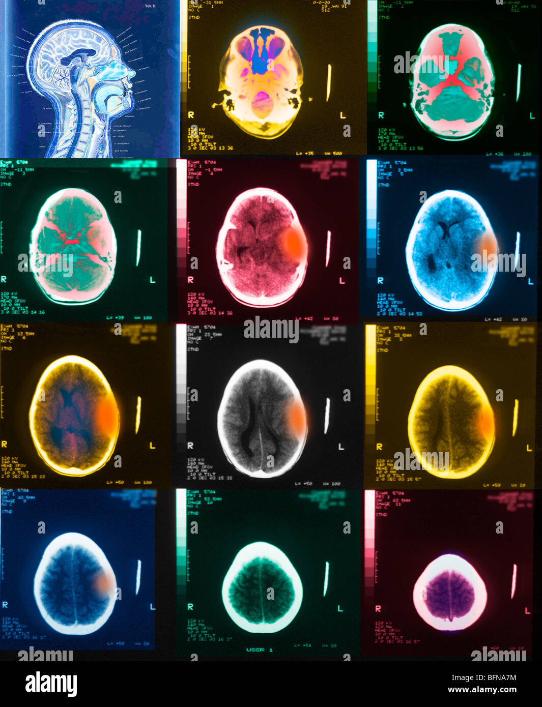 CT scan brain 10 year old boy epidural hematoma from trauma.  The ventricles are compressed and shifted laterally Stock Photo