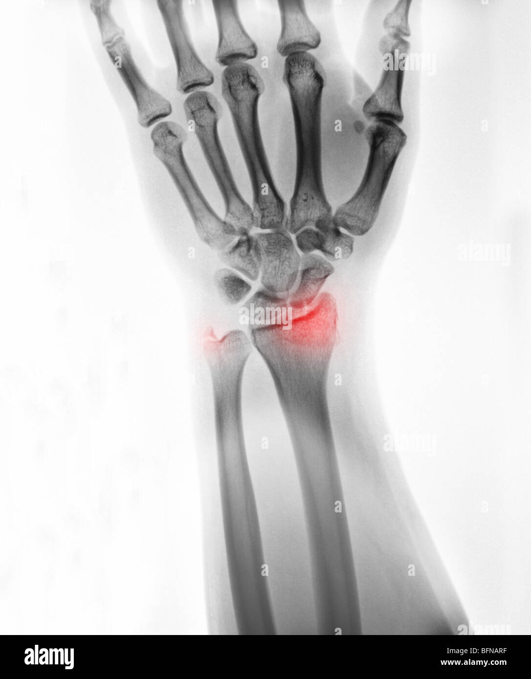 x-ray of the hand and wrist of an 18 year old male showing a fractured wrist at the distal radius and ulnar styloid Stock Photo