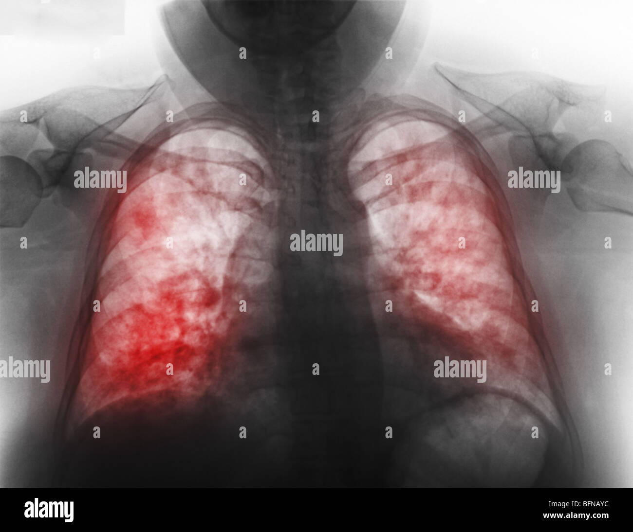 Abnormal Chest X Ray Images