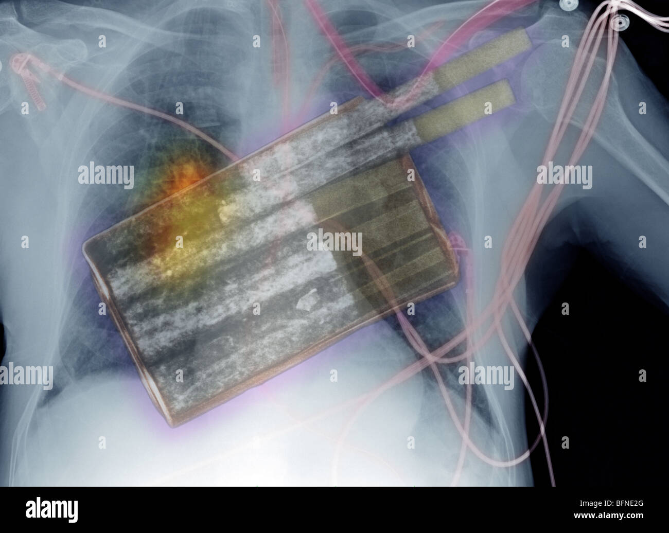 cigarettes, the primary cause of lung cancer, superimposed over a chest x-ray showing lung cancer Stock Photo