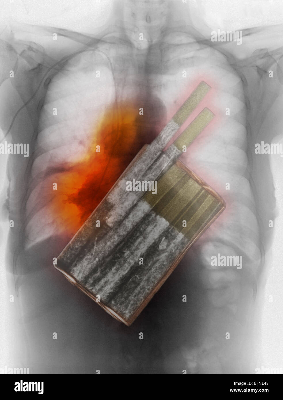 cigarettes, the primary cause of lung cancer, superimposed over a chest x-ray showing lung cancer Stock Photo