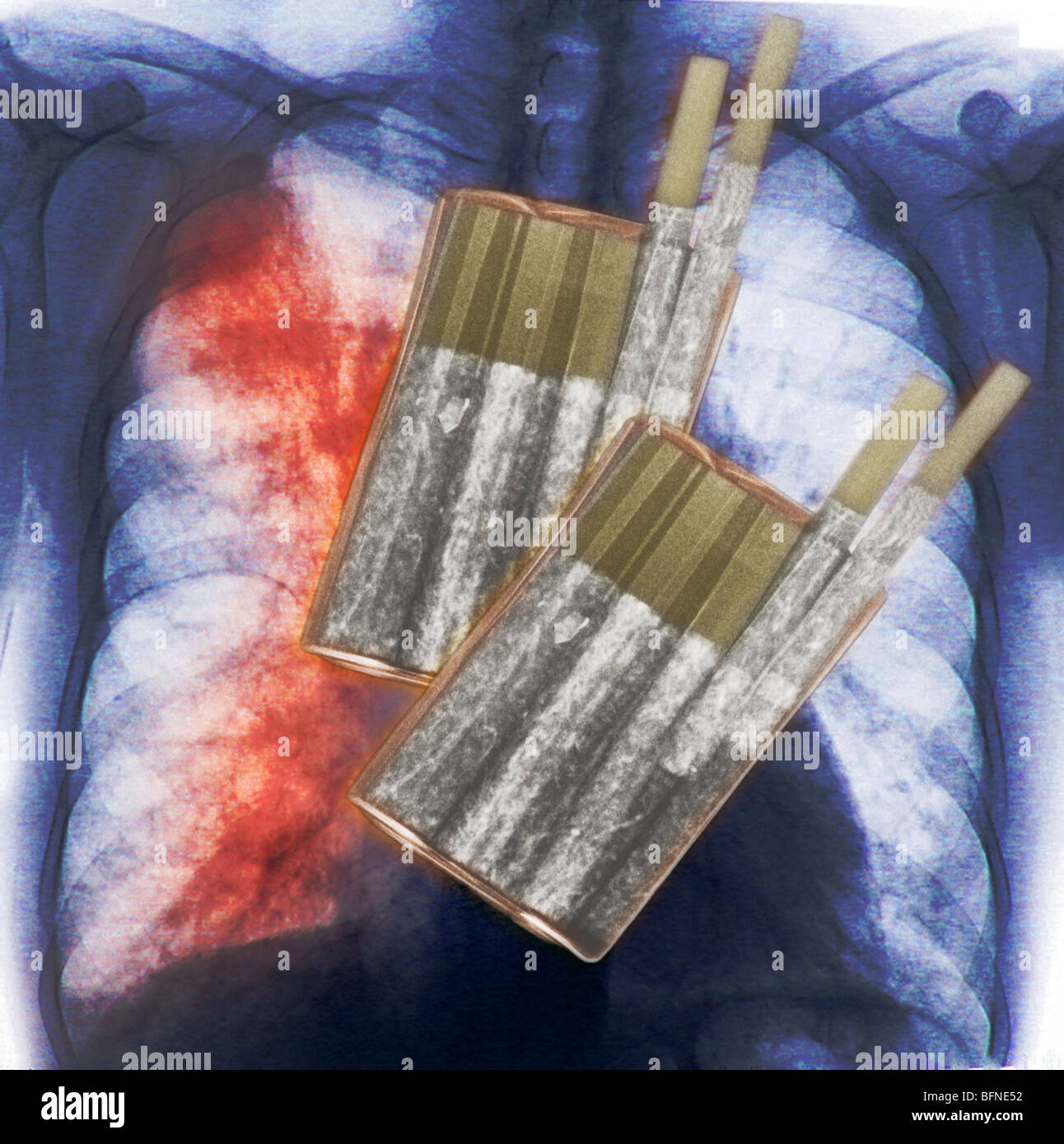 cigarettes, the primary cause of lung cancer, superimposed over a chest